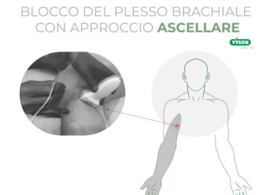 Blocco del plesso brachiale con approccio ascellare
