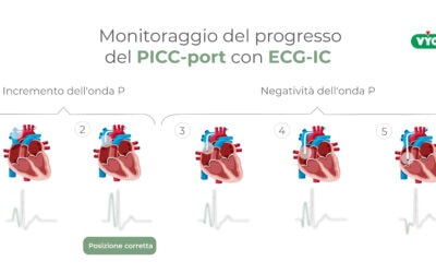 Monitoraggio del progresso del Picc-port con ECG-IC
