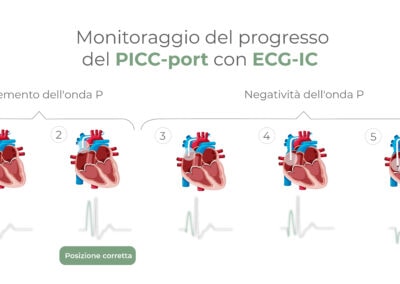Monitoraggio del progresso del Picc-port con ECG-IC