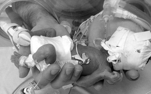 Linee infusionali in ambito neonatale: basi-gestione-prevenzione